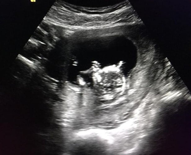 ultraschall 12 ssw junge1