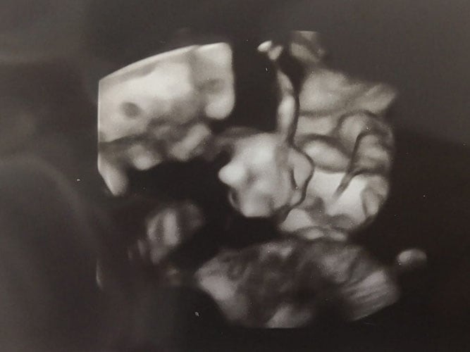 ultraschall 22 ssw junge