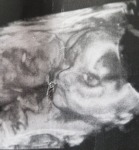 ultraschall 29 ssw junge