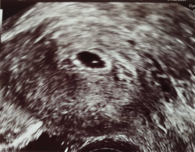 ultraschall 6 ssw junge